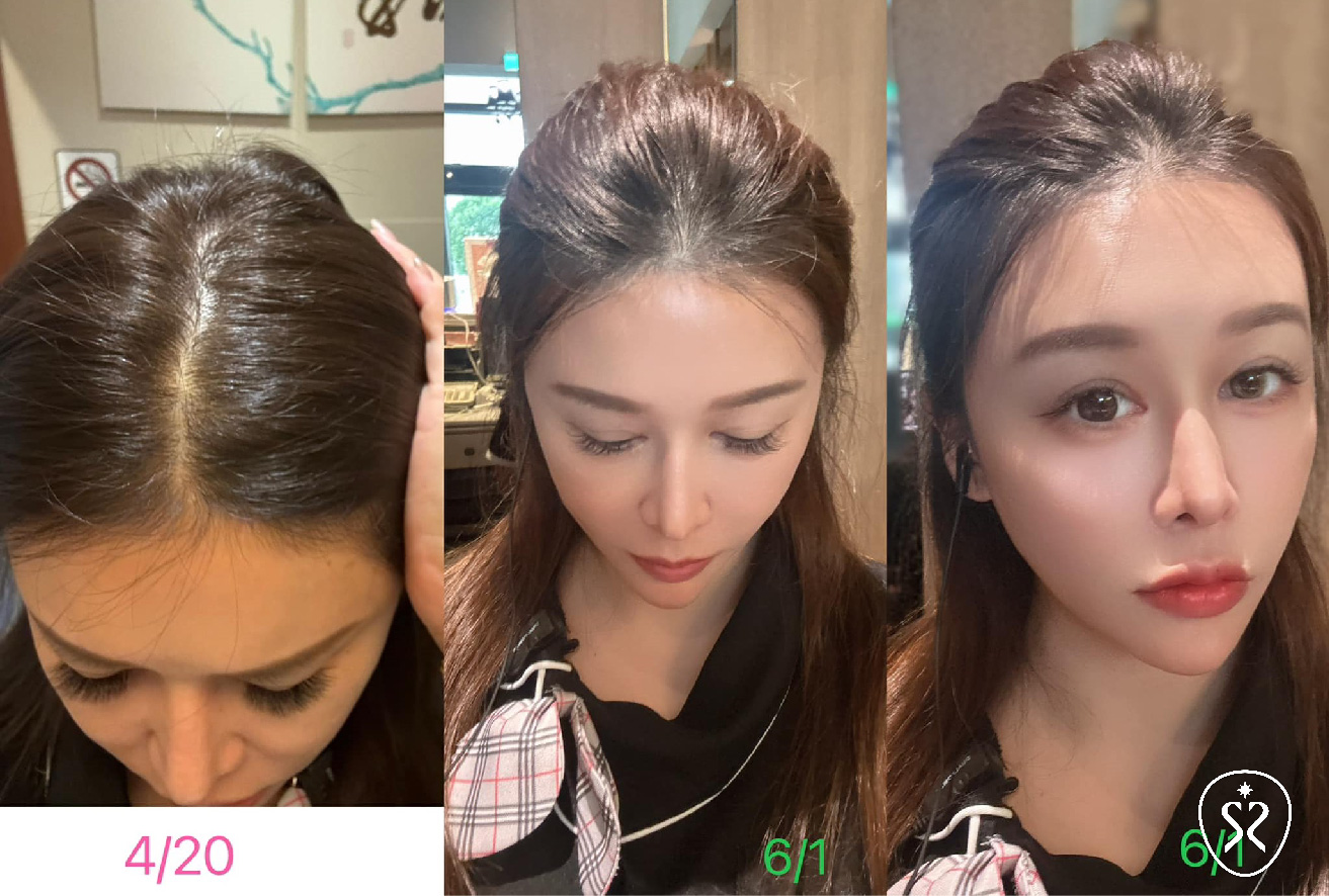  台中星和診所透過複合式生髮療程，拯救我細小脆弱的頭髮，解決我掉髮問題